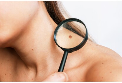 Dermatologinis apgamo ištyrimas ir šalinimas lazeriu klinikoje „Era Esthetic“